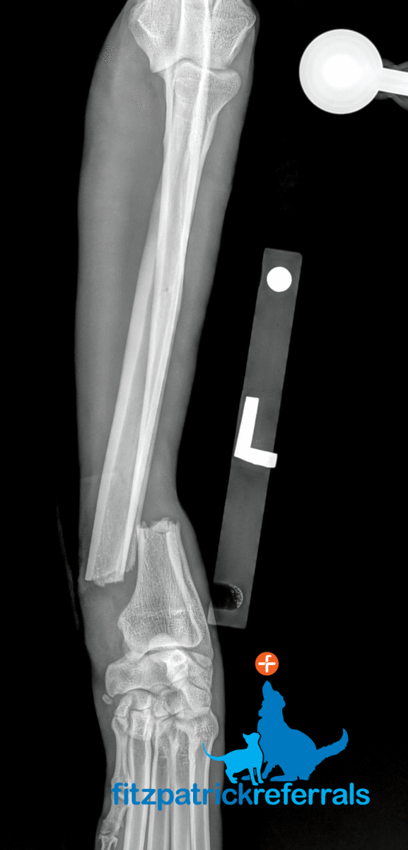 X-ray of a complete, displaced, transverse fracture of the left distal radius and ulna