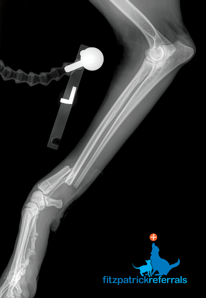 X-ray of a complete, displaced, transverse fracture of the left distal radius and ulna