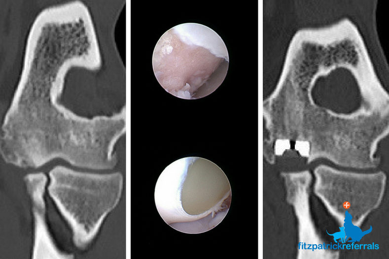 CT scans and arthroscopy pre- and post-operatively for Osteochondritis Dissecans (OCD) of the medial aspect of the humeral condyle treated with SynACART™ implant - Fitzpatrick Referrals