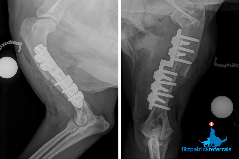 Radiograph of a Custom Sliding Humeral Osteotomy (cSHO) - Fitzpatrick Referrals