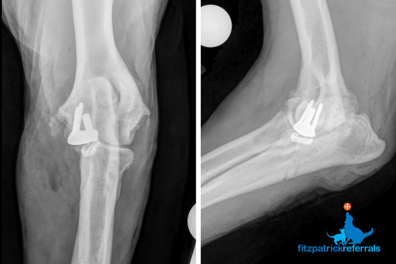 Radiograph of an Elbow Custom Medial Compartment Replacement (cMCR) - Fitzpatrick Referrals