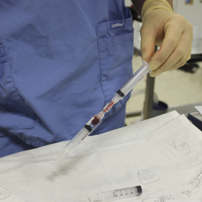 Preparing the stem cells for injection into the patient at Fitzpatrick Referrals Preparing the stem cells for injection into the patient at Fitzpatrick Referrals