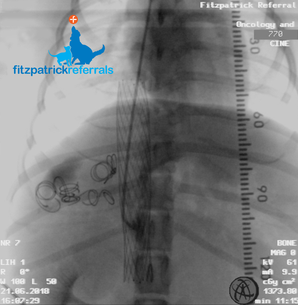 Fluoroscopy image showing the stent placed within the caudal vena cava and multiple platinum coils placed within both shunts. Scan of Fitzpatrick Referrals Oncology & Soft Tissue double shunt patient Teddy
