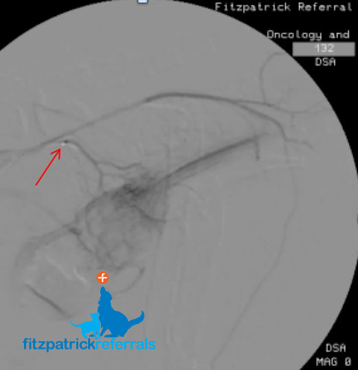 A fluoroscopic digital subtraction angiography (DSA)