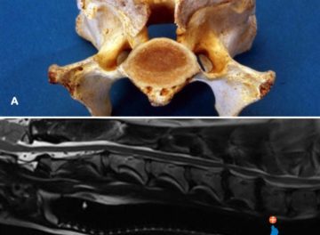 Post-mortem sample of a vertebra and an MRI scan of intervertebral disc protrusions