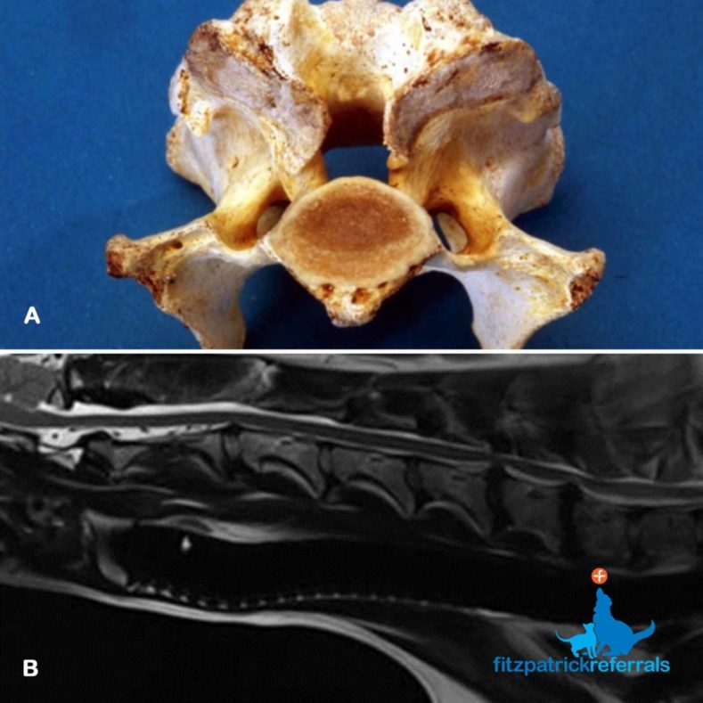 Post-mortem sample of a vertebra and an MRI scan of intervertebral disc protrusions
