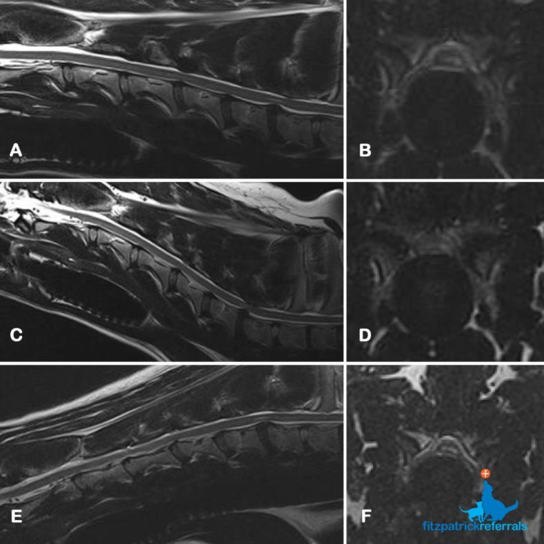 MRI sagittal and transverse images of intervertbral disc protrusion