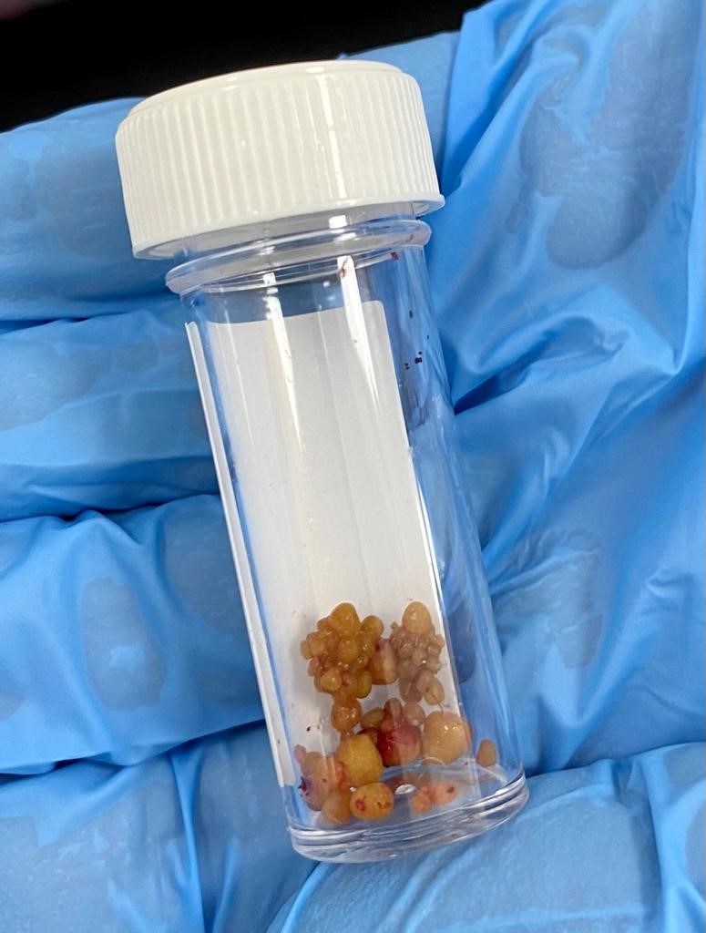 Urinary stones removed from a dog