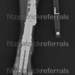 Radiograph of a radial endoprosthesis 3 years post operation at Fitzpatrick Referrals