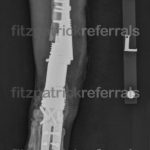 Radiograph of a radial endoprosthesis post operation at Fitzpatrick Referrals