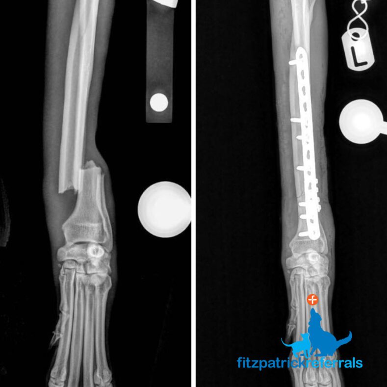 X-ray of fracture of the left distal radius and ulna fixed using plates and screws