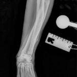 Radiograph of a dog with antebrachial growth deformity