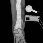 Radiograph of dog immediately after antebrachial growth deformity correction surgery