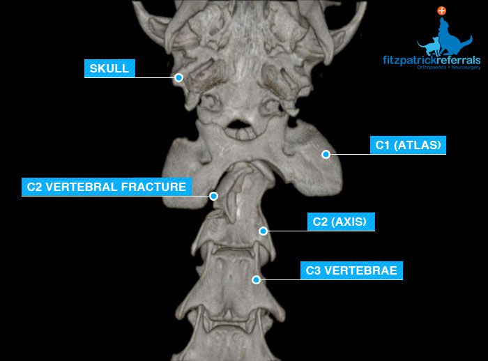 C2 Fracture Neck - Fitzpatrick Referrals