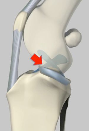 Cruciate Ligament Anatomy Cruciate ligament disease or injury