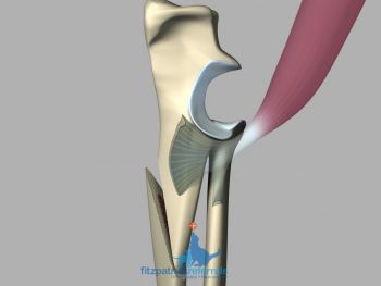 The effect of a bioblique dynamic proximal ulnar osteotomy on the medial coronoid process.