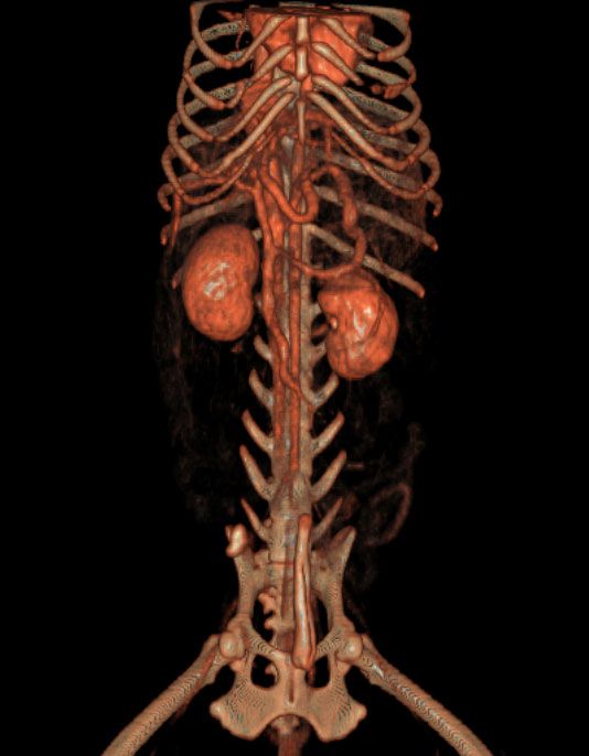 Abdominal CT