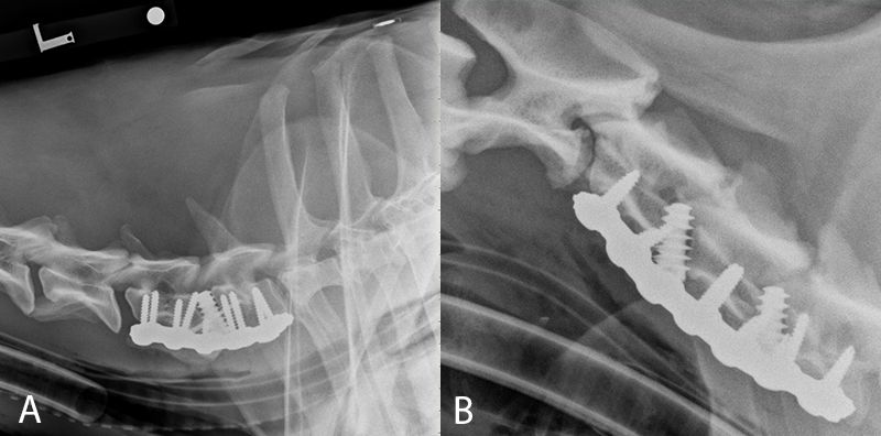 Cervical Distraction Fusion - (A) Single Site Fusion / (B) Double Site Fusion Cervical spondylomyelopathy (wobbler syndrome)